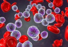 aplastic-anemia